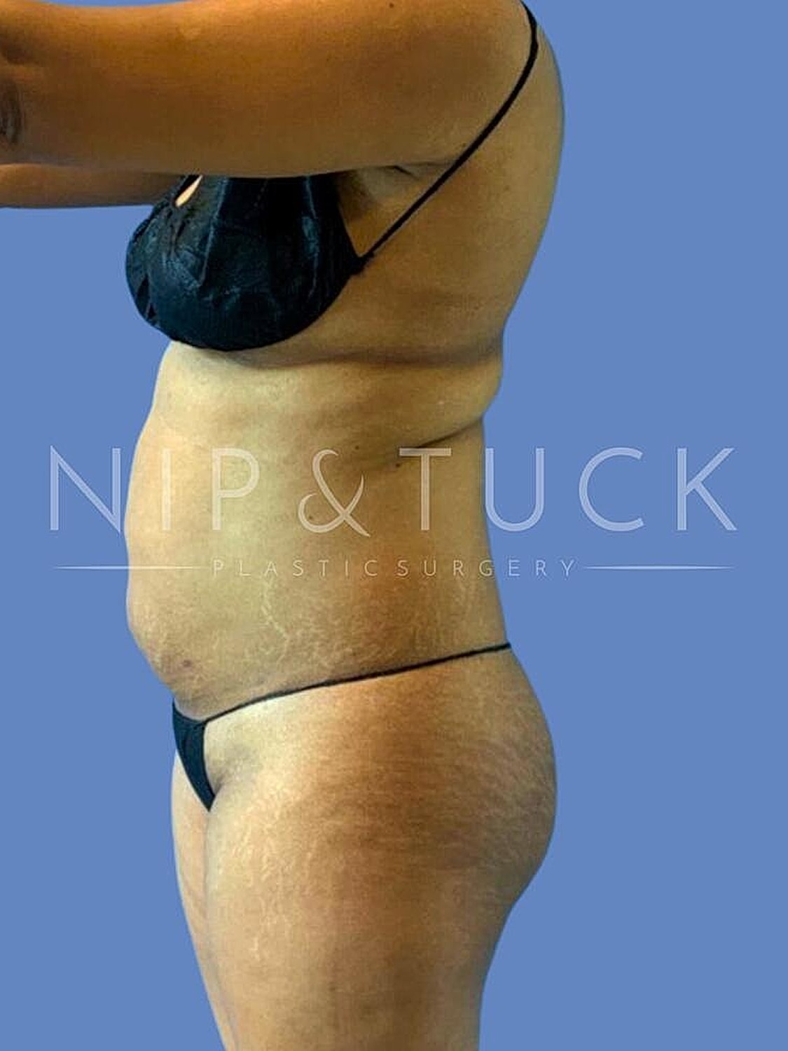Brazilian Butt Lift Before & After