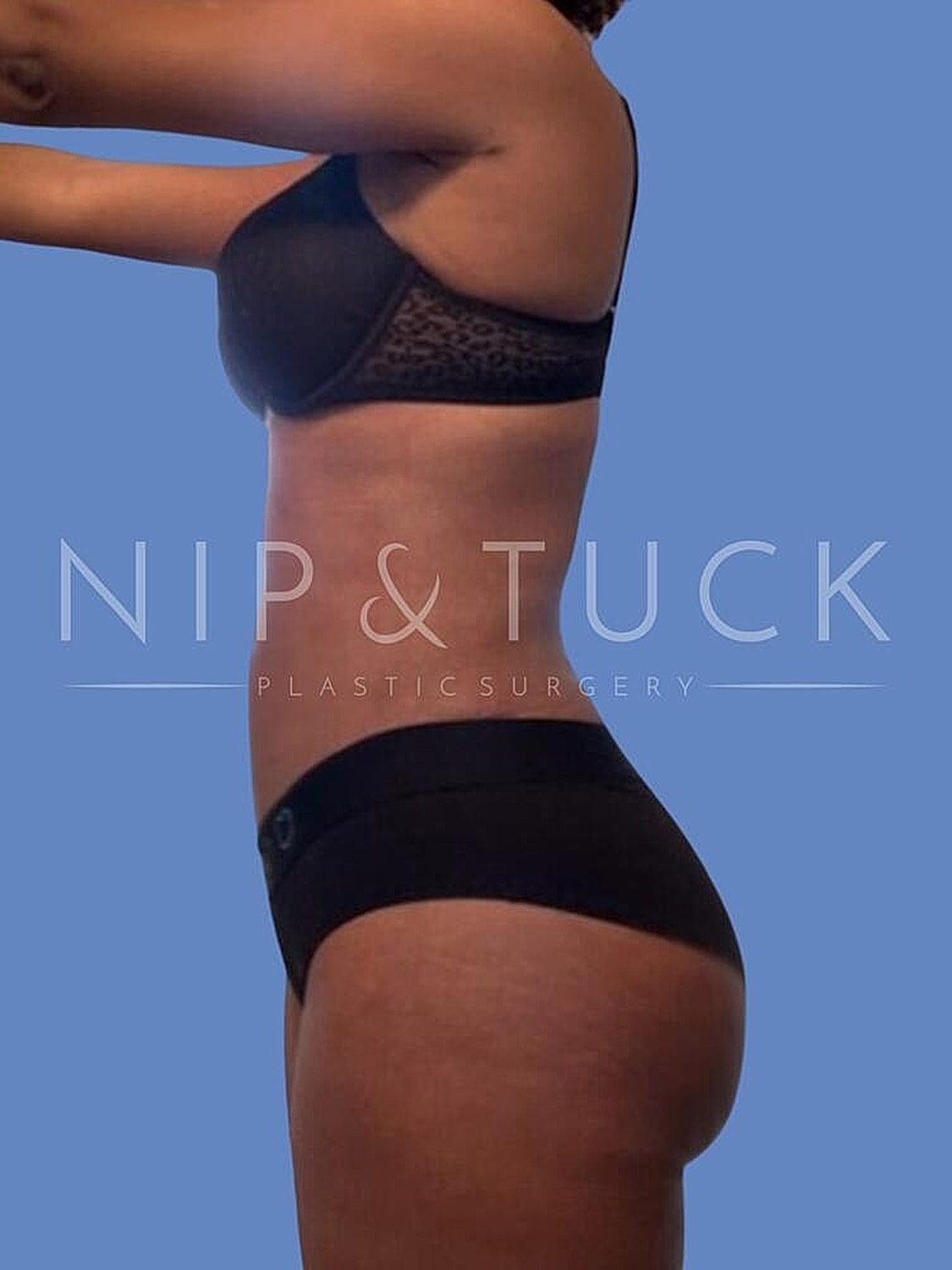 Brazilian Butt Lift Before & After