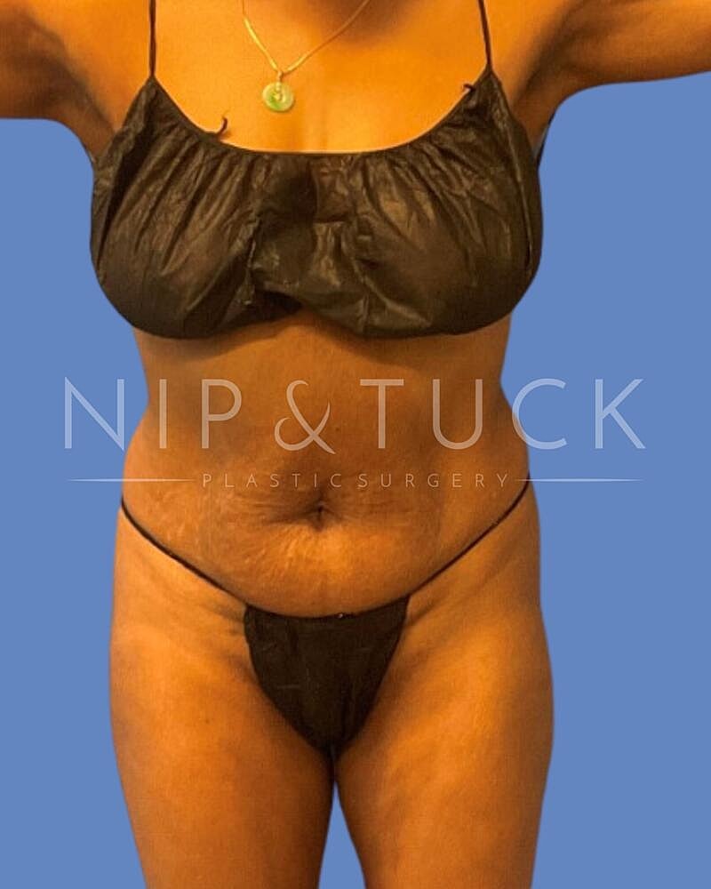 Brazilian Butt Lift Before & After