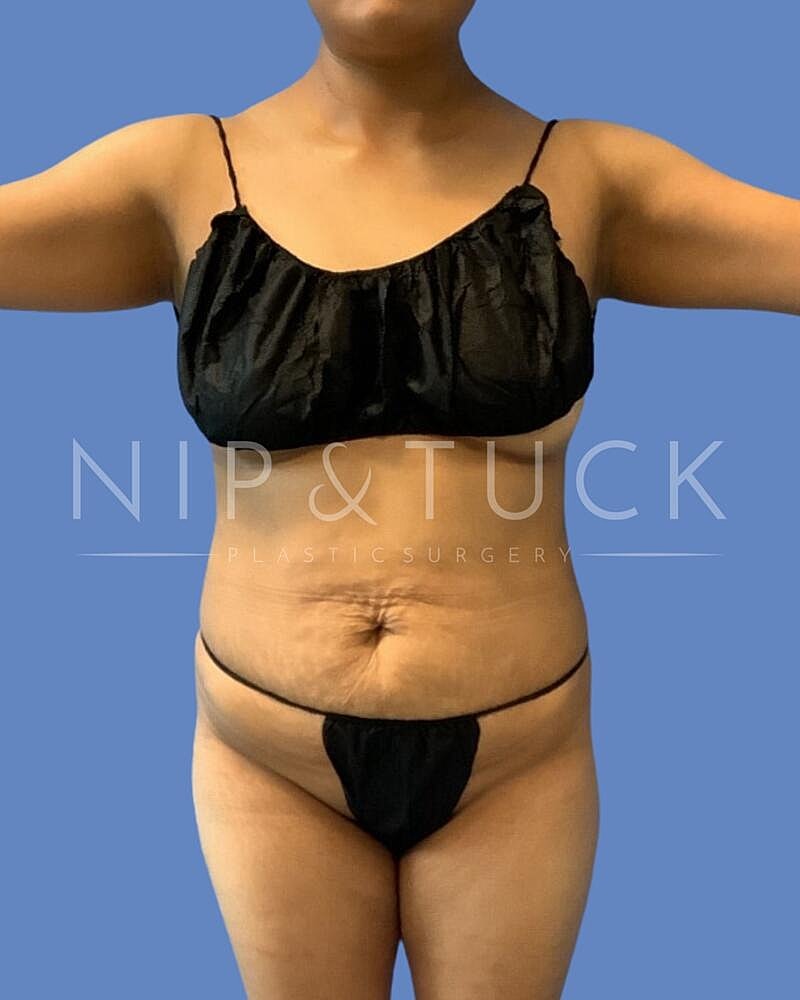 Brazilian Butt Lift Before & After