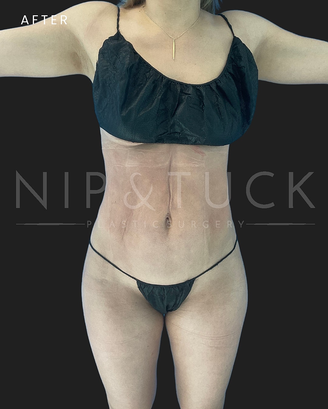 Brazilian Butt Lift Before & After