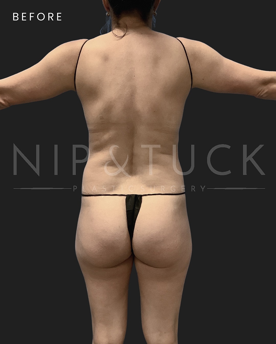 Brazilian Butt Lift Before & After