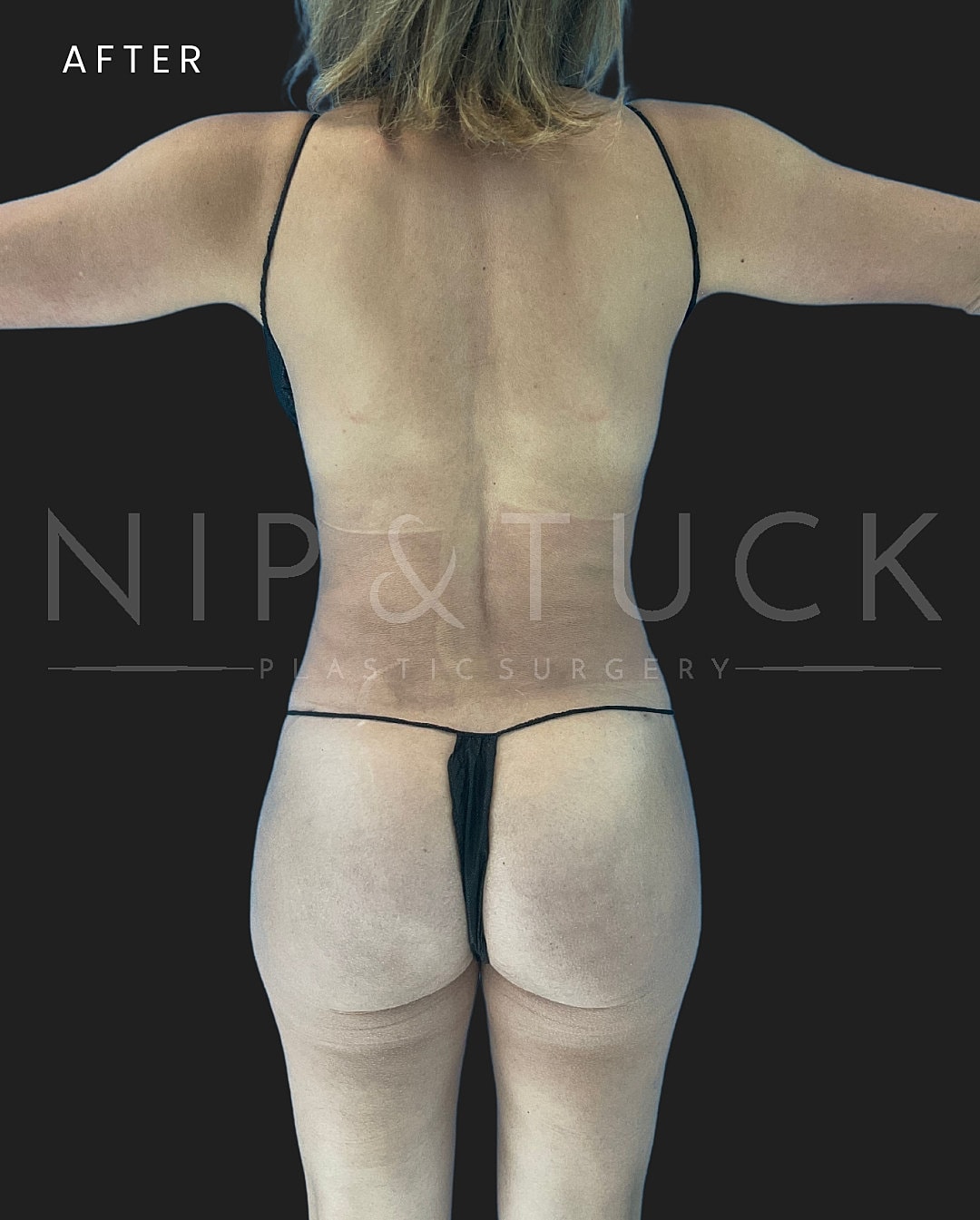 Brazilian Butt Lift Before & After