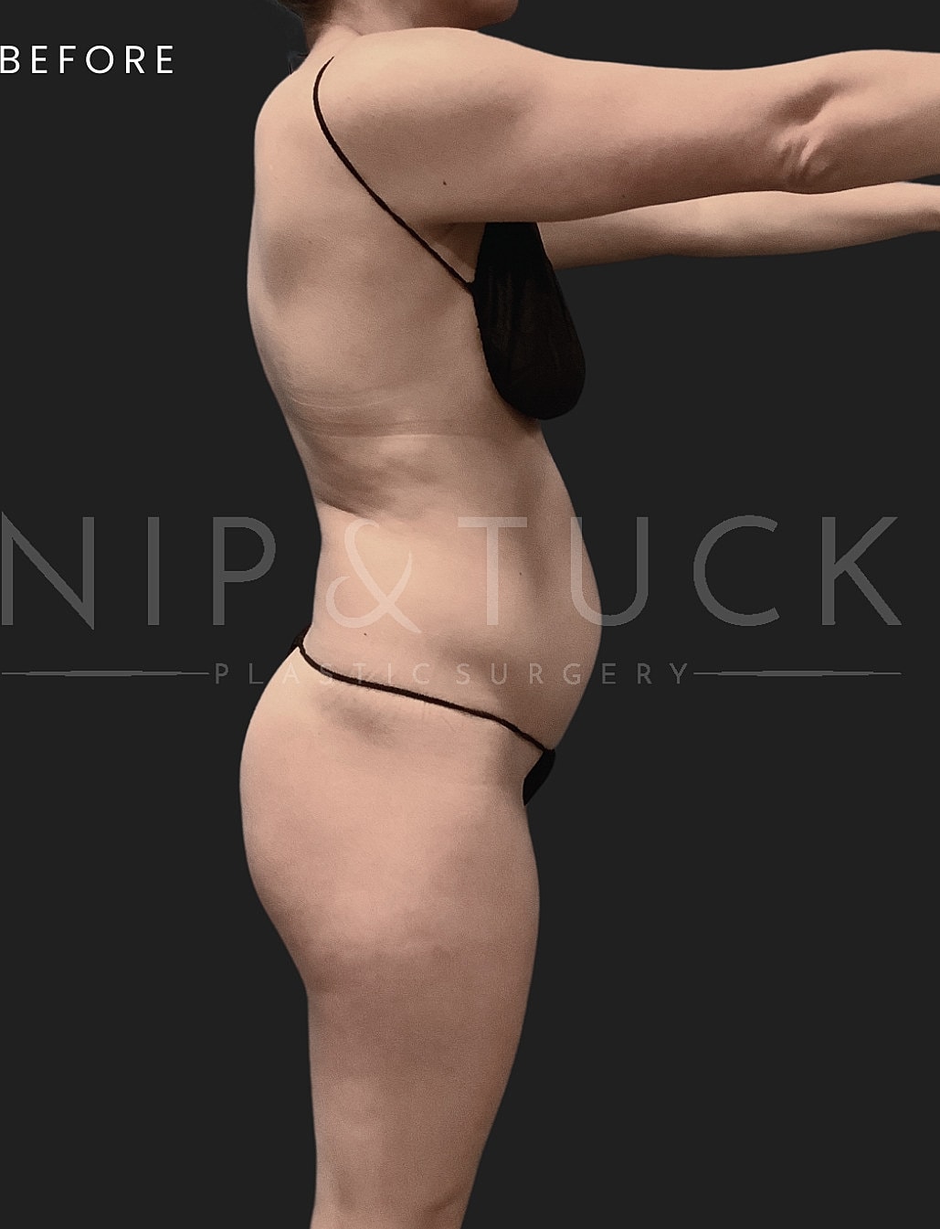 Brazilian Butt Lift Before & After