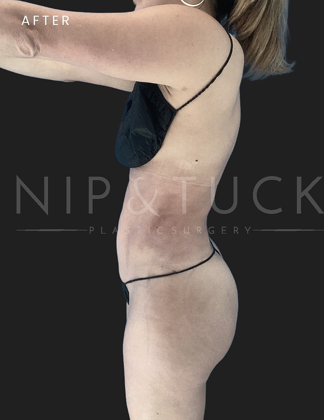 Brazilian Butt Lift Before & After