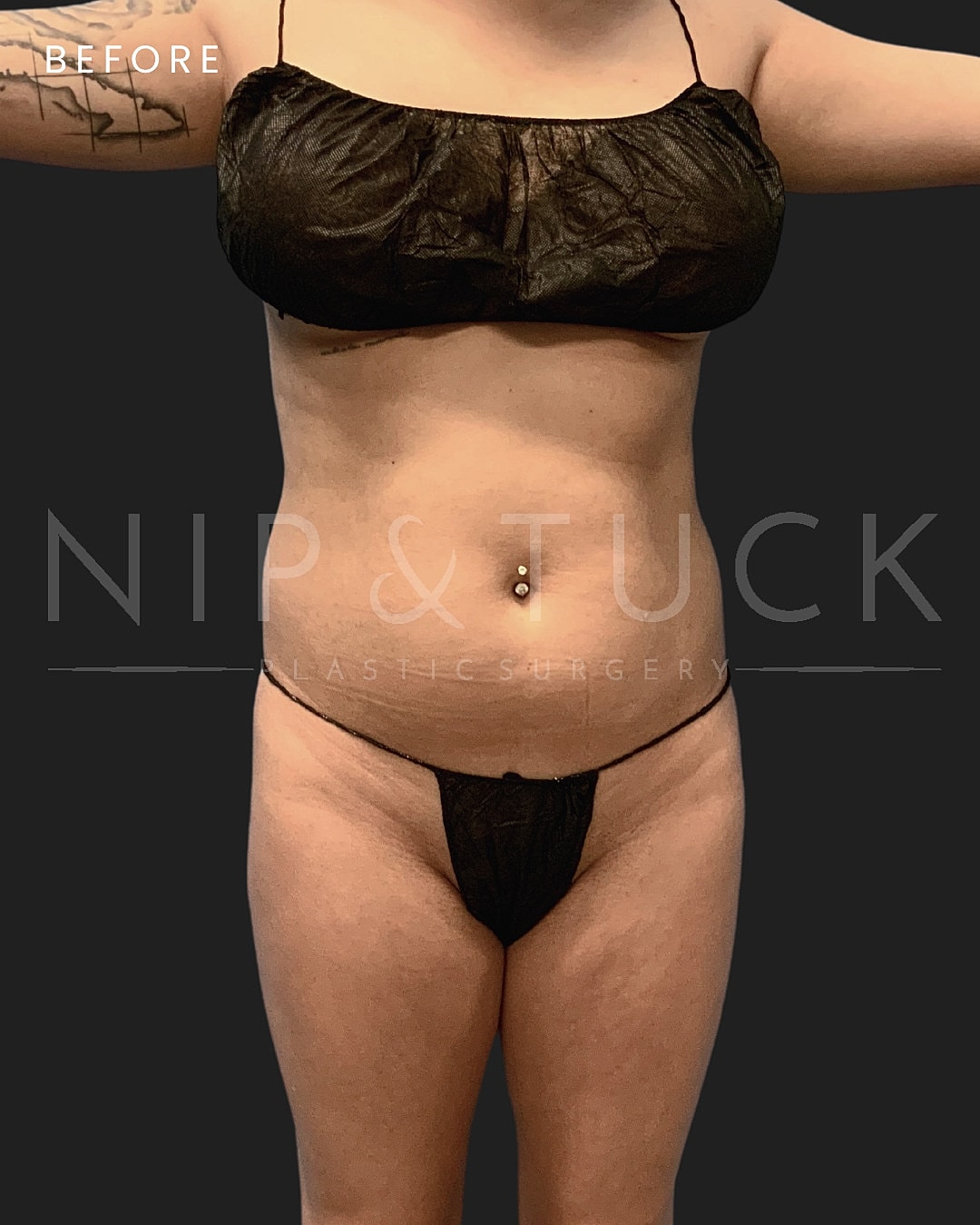 Brazilian Butt Lift Before & After