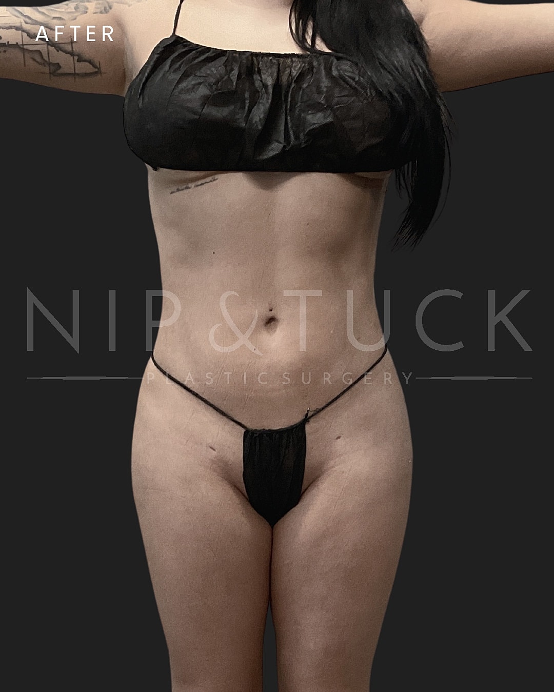 Brazilian Butt Lift Before & After