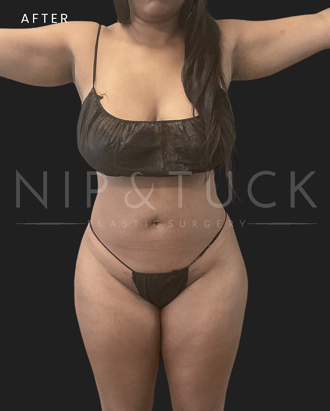 Brazilian Butt Lift Before & After