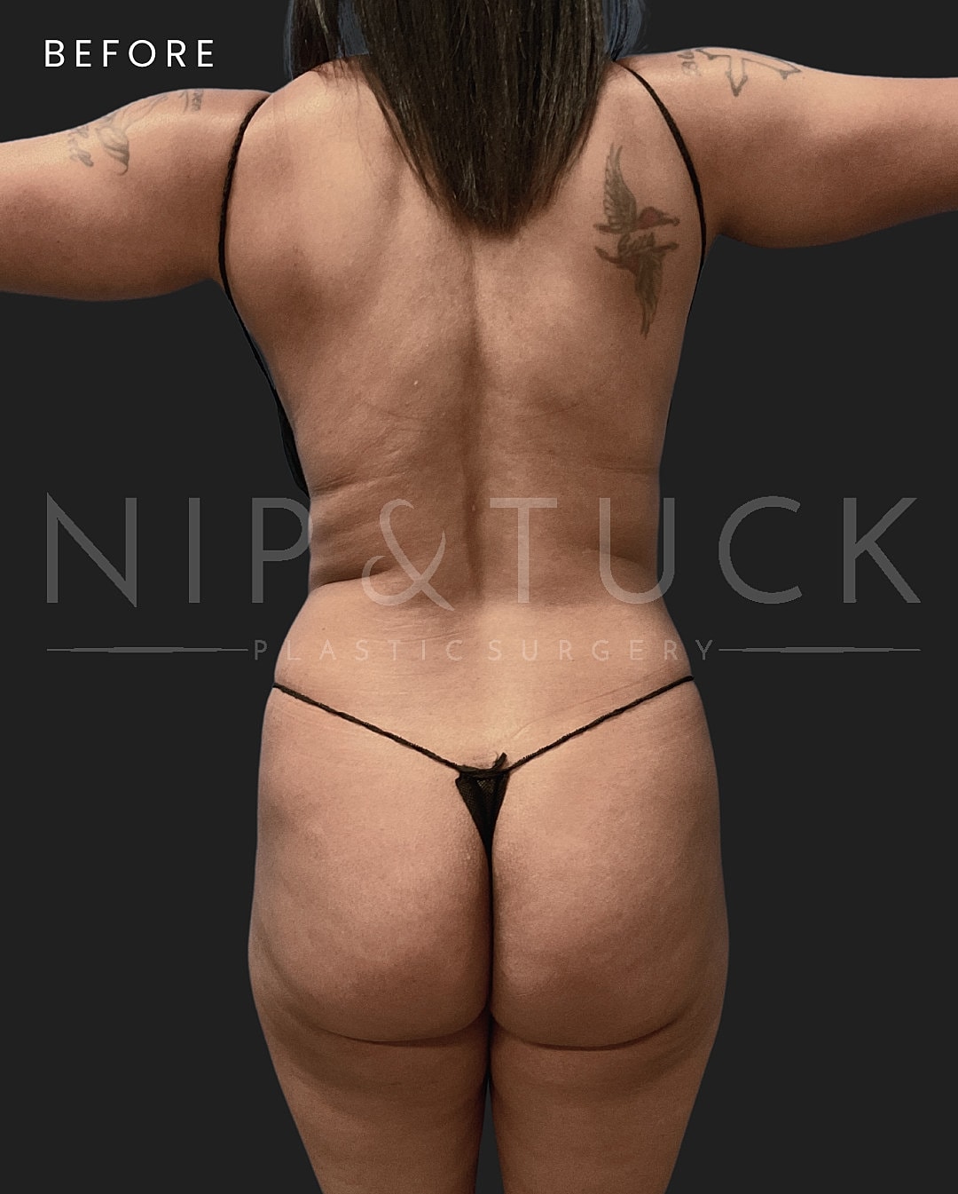 Brazilian Butt Lift Before & After