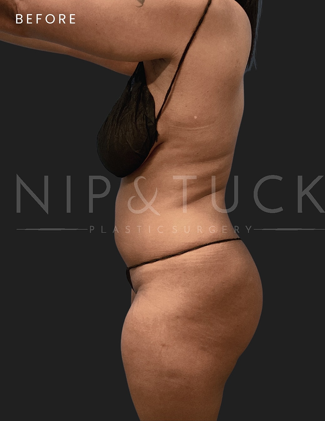Brazilian Butt Lift Before & After