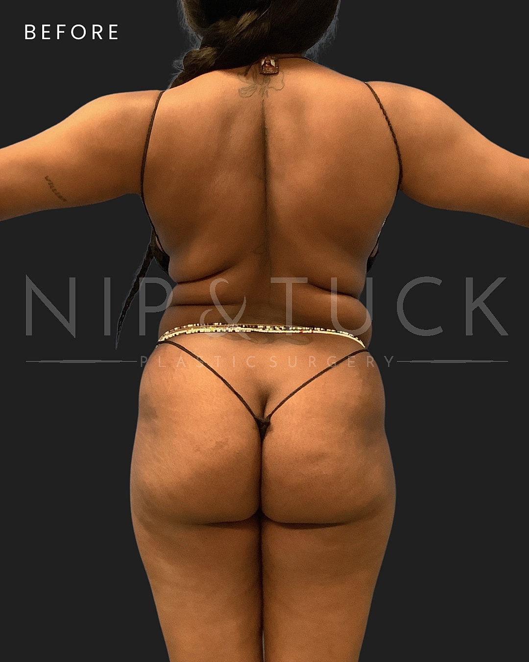 Brazilian Butt Lift Before & After