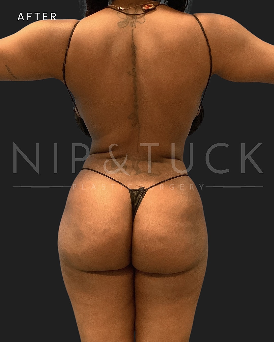 Brazilian Butt Lift Before & After