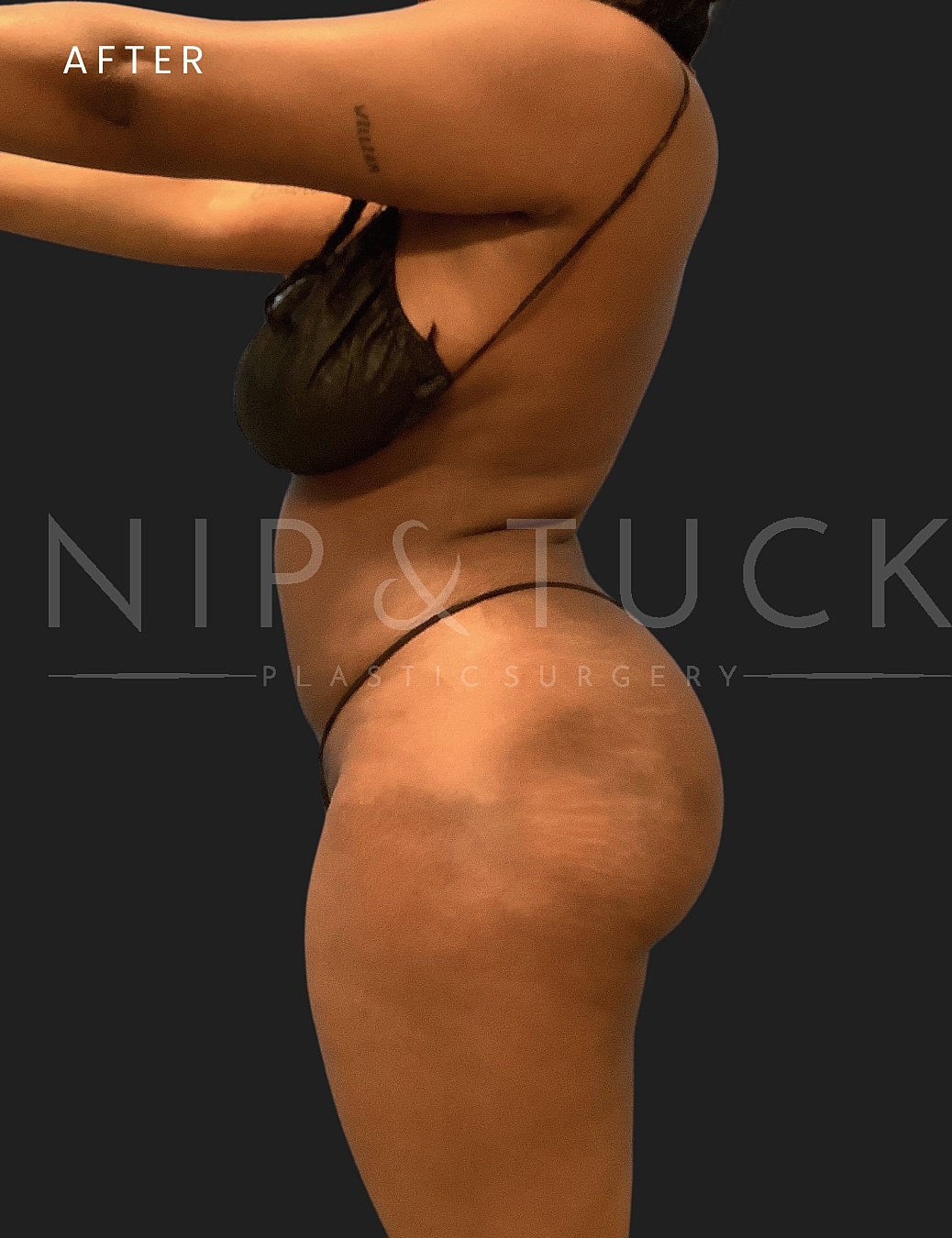 Brazilian Butt Lift Before & After