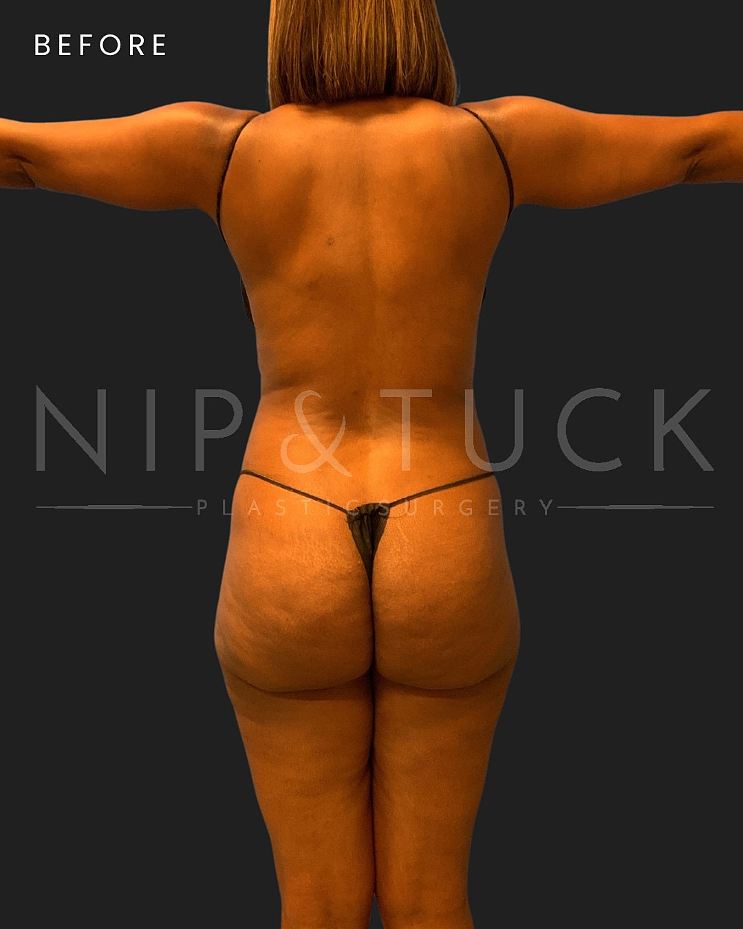 Brazilian Butt Lift Before & After