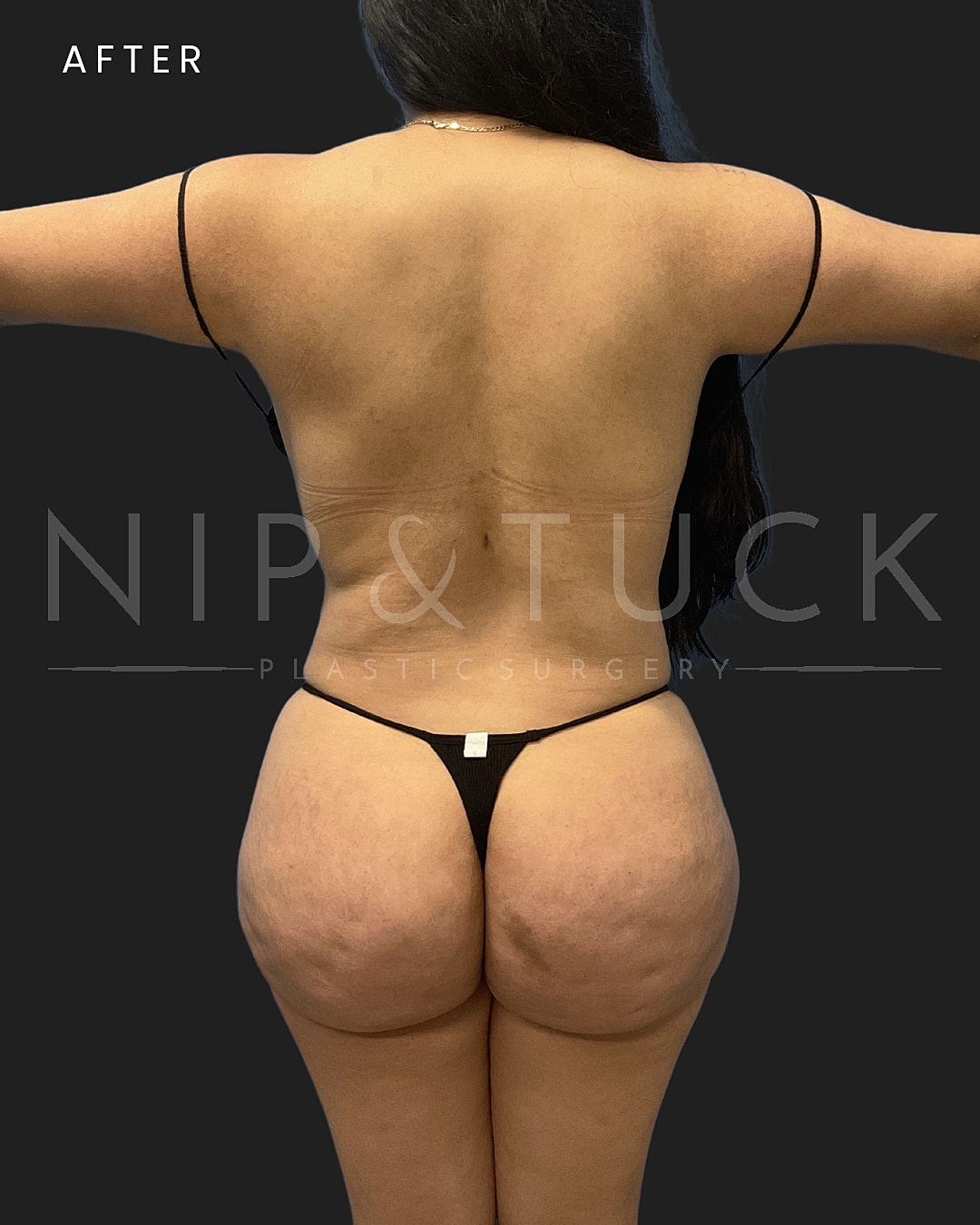 Brazilian Butt Lift Before & After