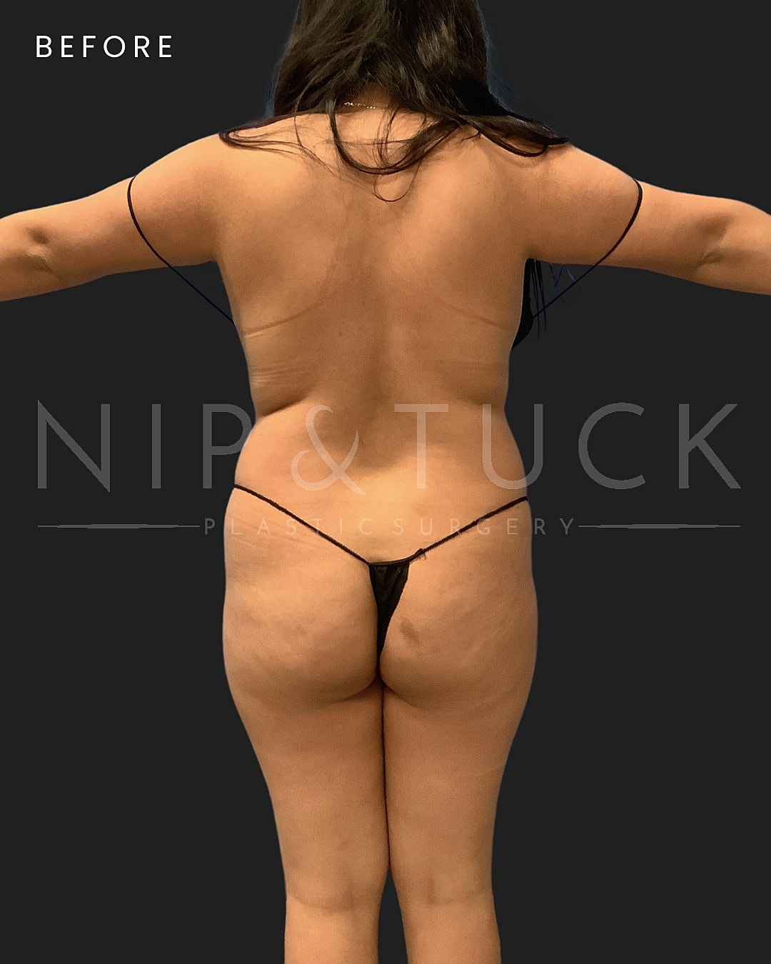Brazilian Butt Lift Before & After