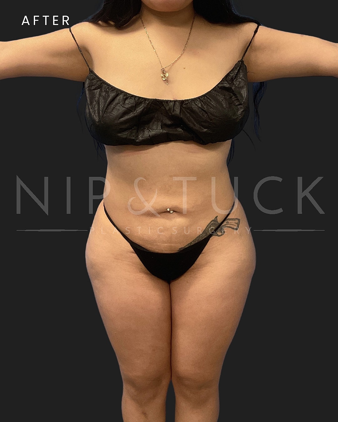 Brazilian Butt Lift Before & After