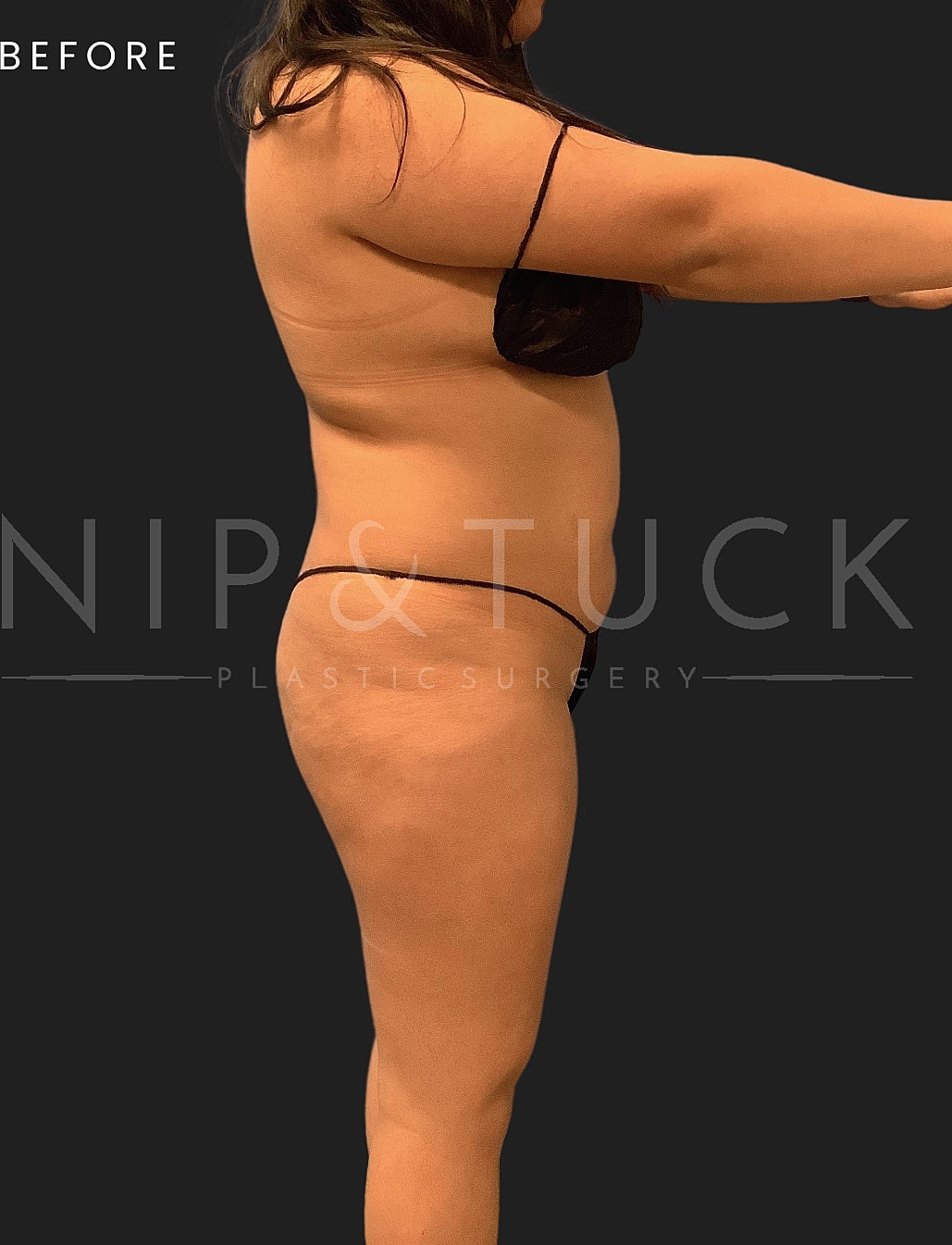 Brazilian Butt Lift Before & After