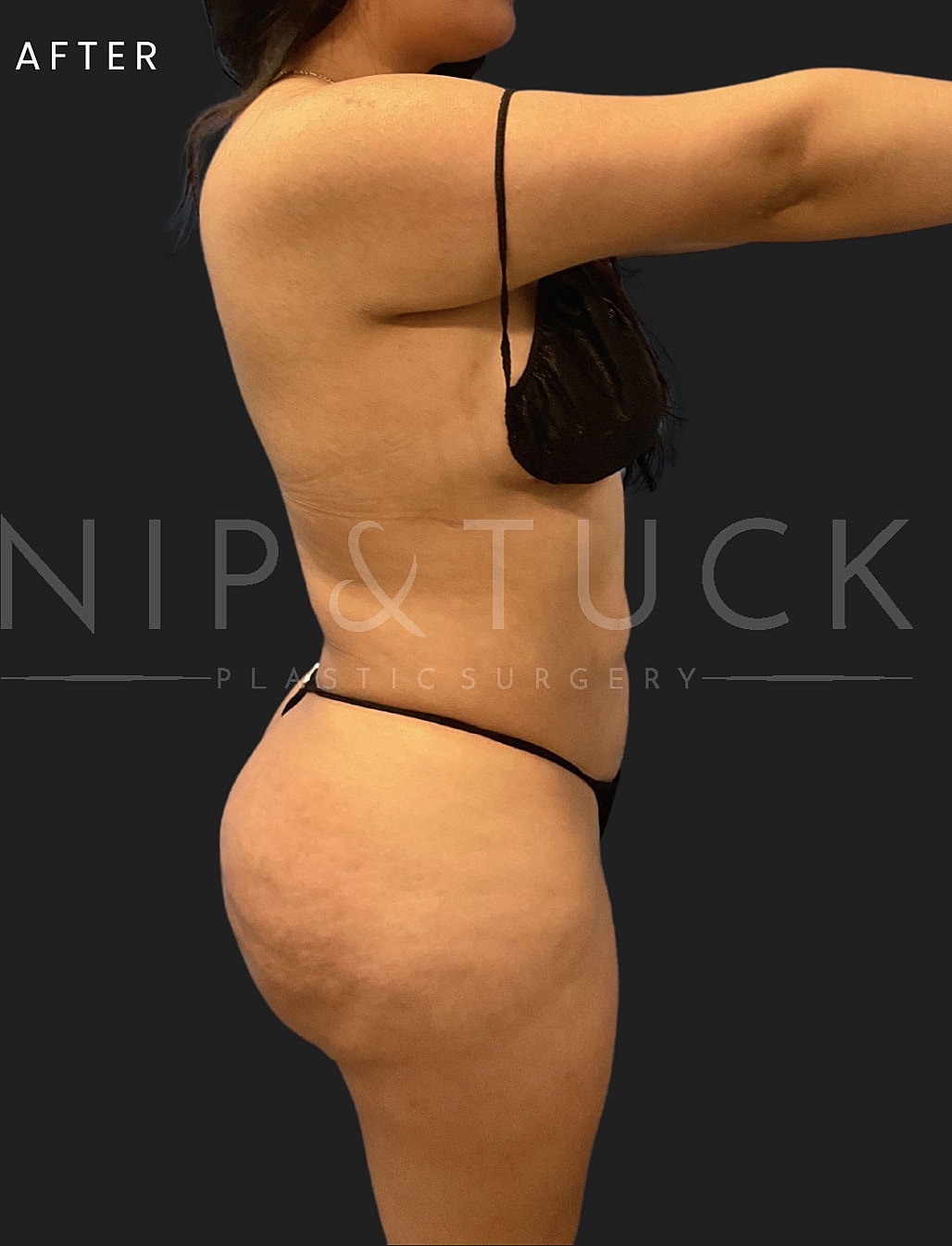 Brazilian Butt Lift Before & After