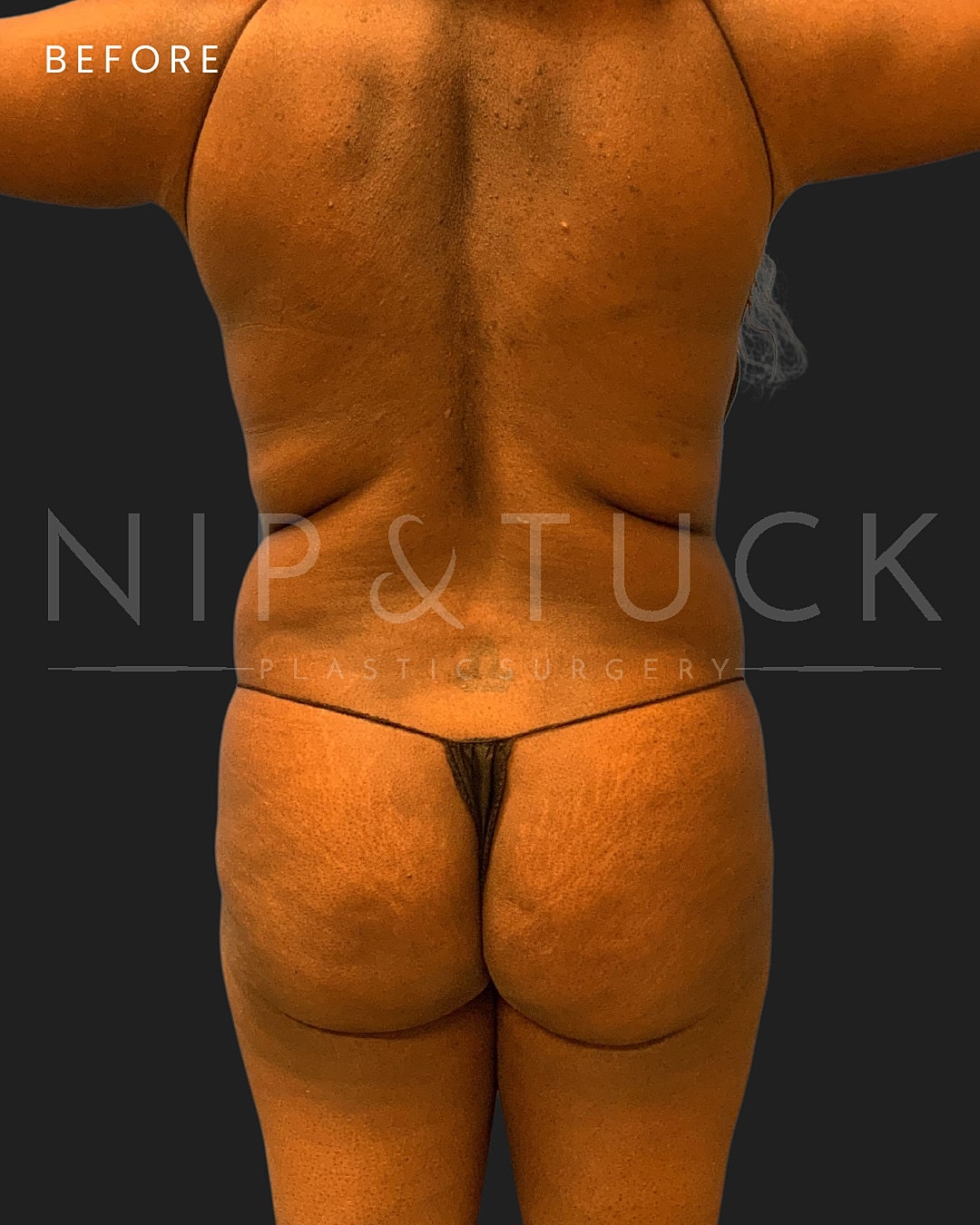 Brazilian Butt Lift Before & After