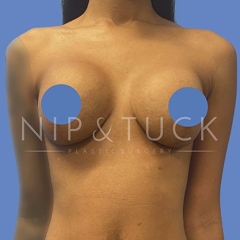 Augmentation Mastopexy Before & After