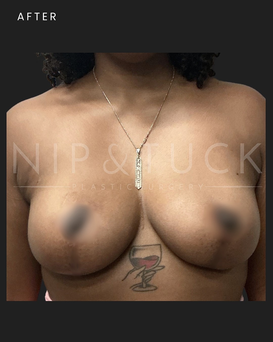 Augmentation Mastopexy Before & After