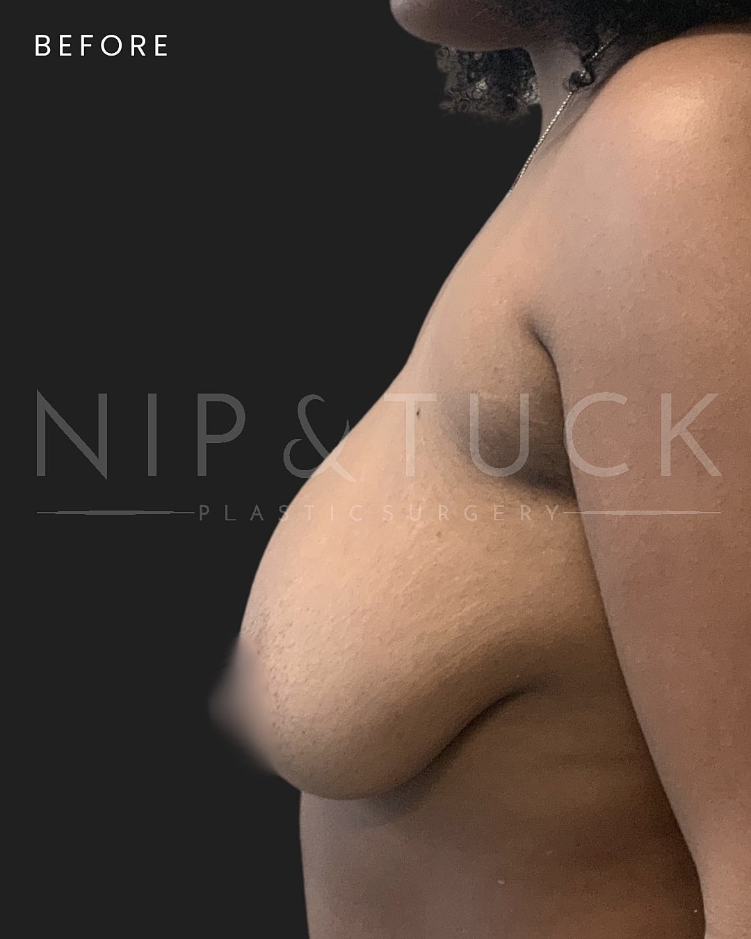 Augmentation Mastopexy Before & After