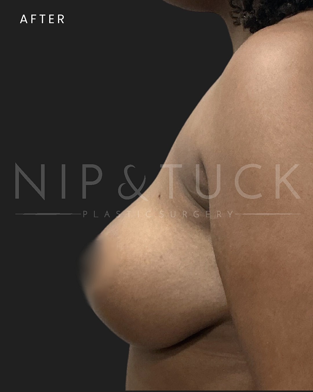 Augmentation Mastopexy Before & After
