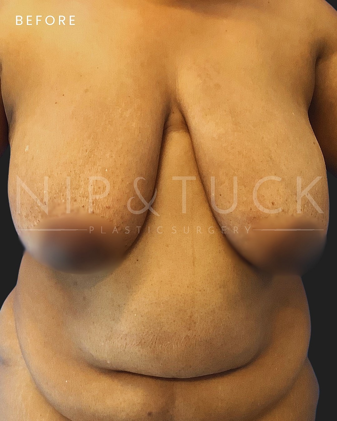 Augmentation Mastopexy Before & After
