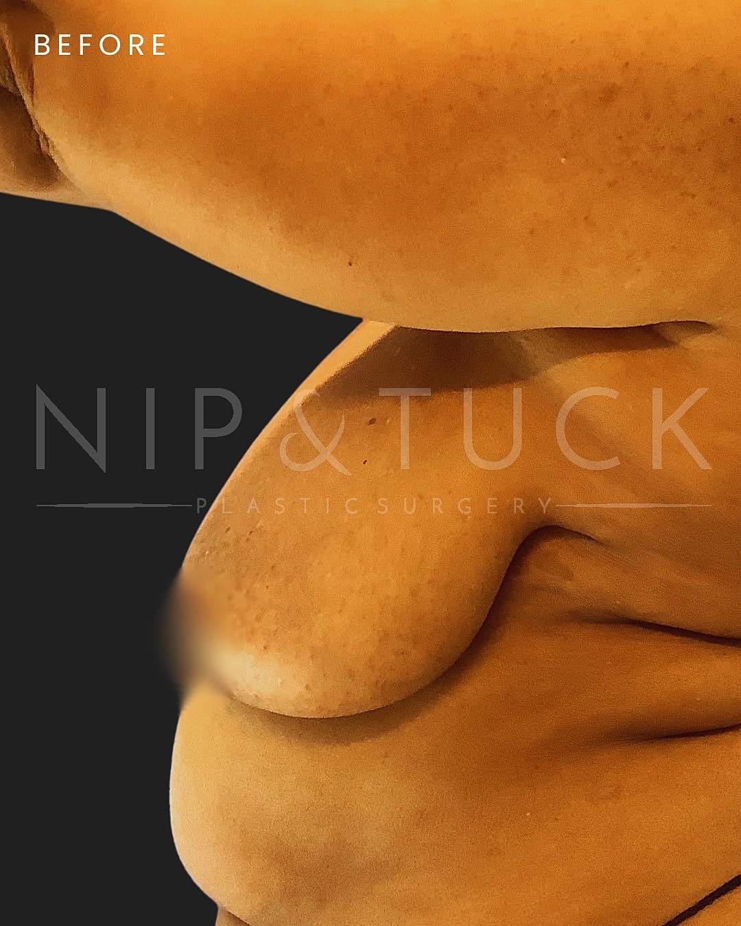 Augmentation Mastopexy Before & After