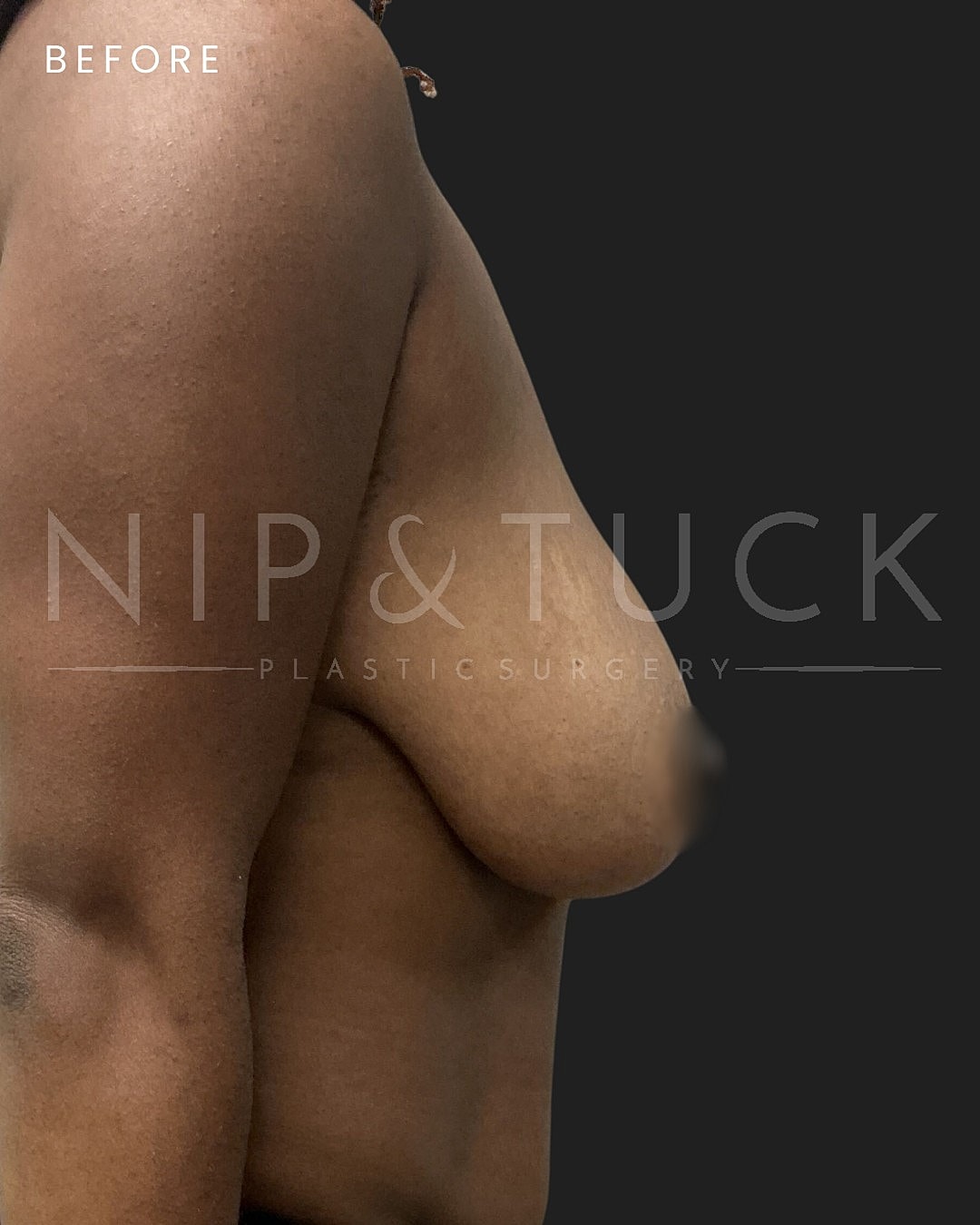 Augmentation Mastopexy Before & After
