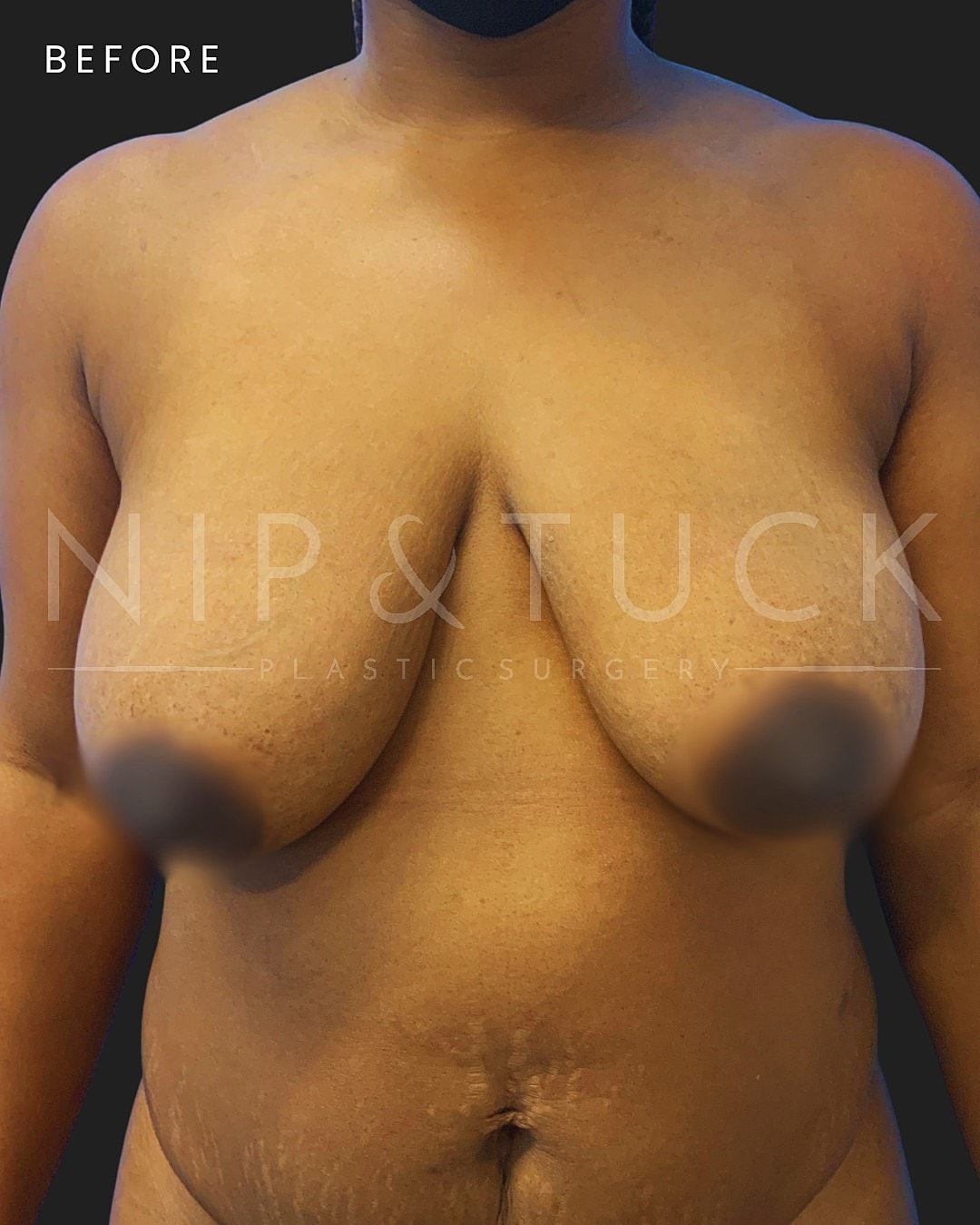 Augmentation Mastopexy Before & After