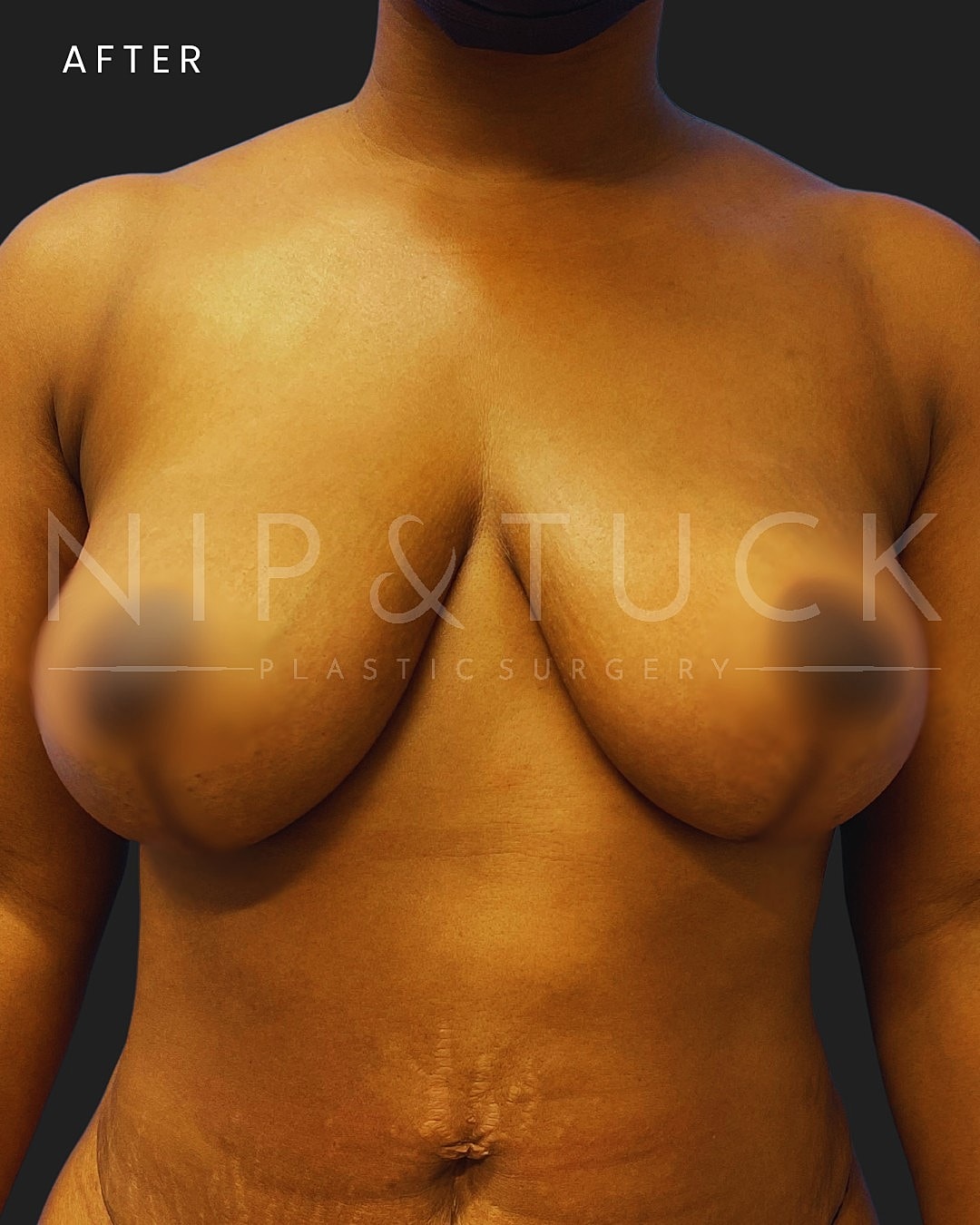 Augmentation Mastopexy Before & After