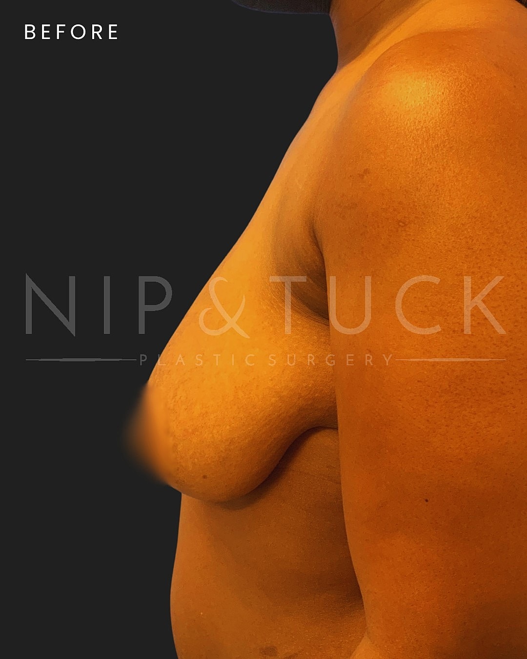 Augmentation Mastopexy Before & After