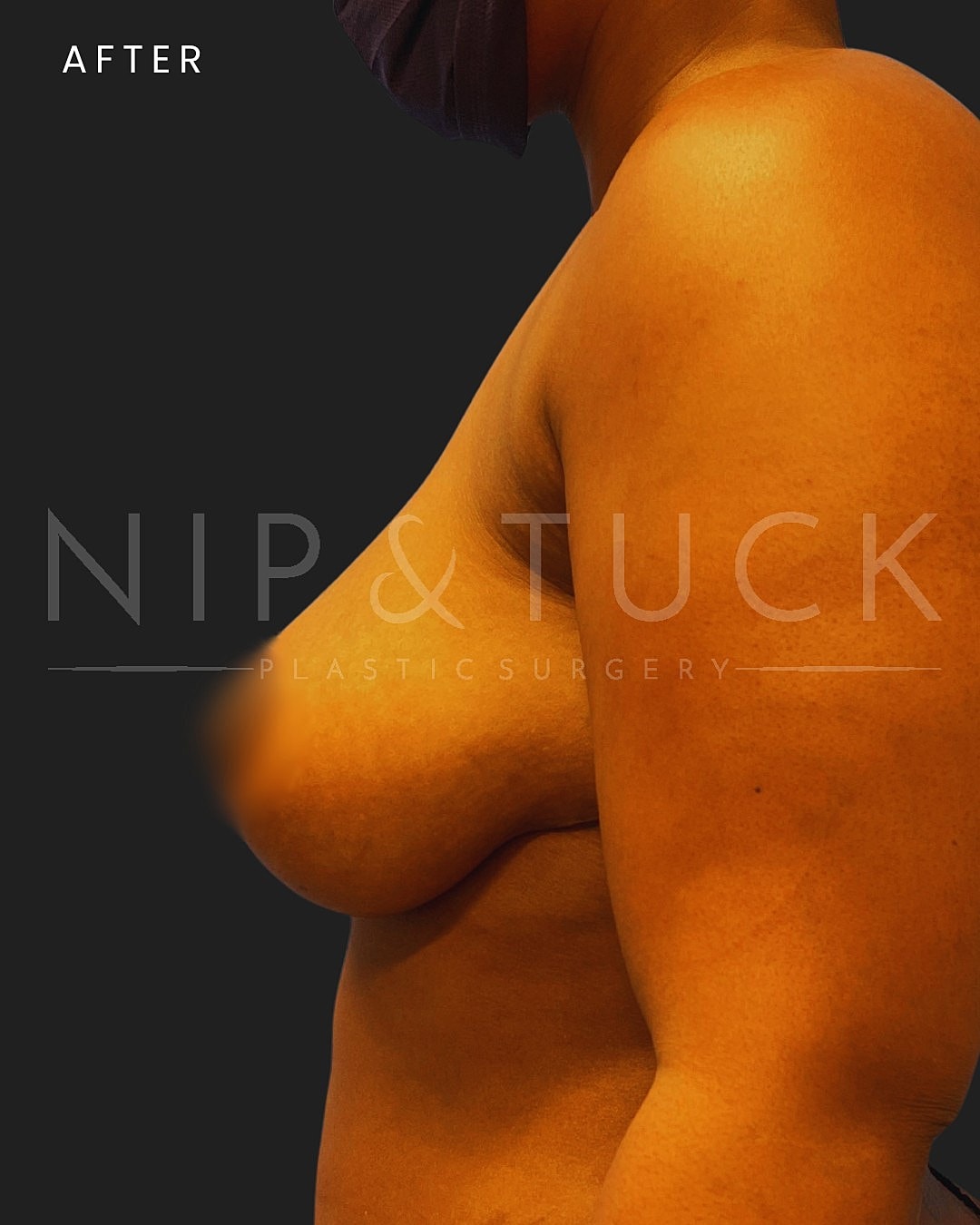 Augmentation Mastopexy Before & After