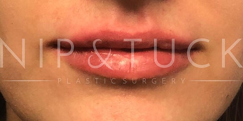 Lip Fillers Before & After
