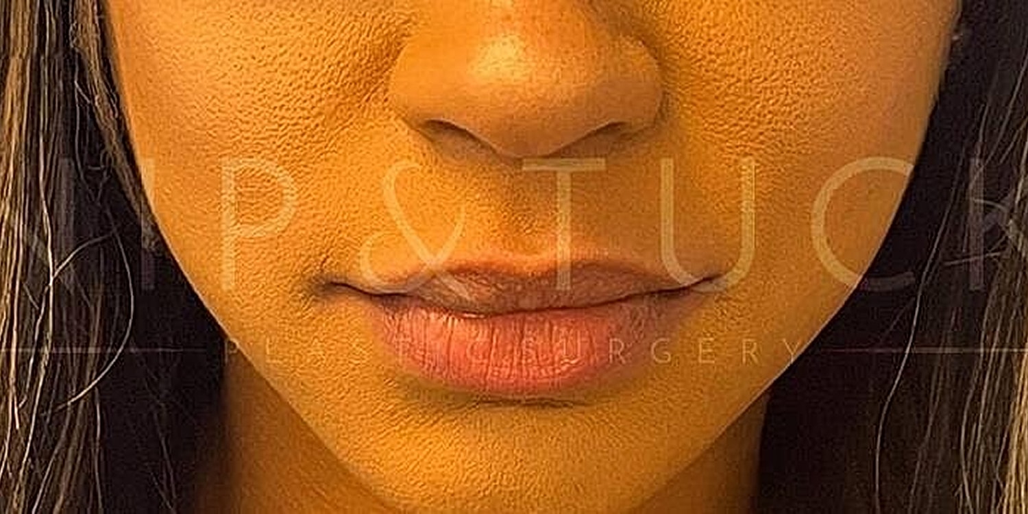Close-up of lips and nose with textured skin.