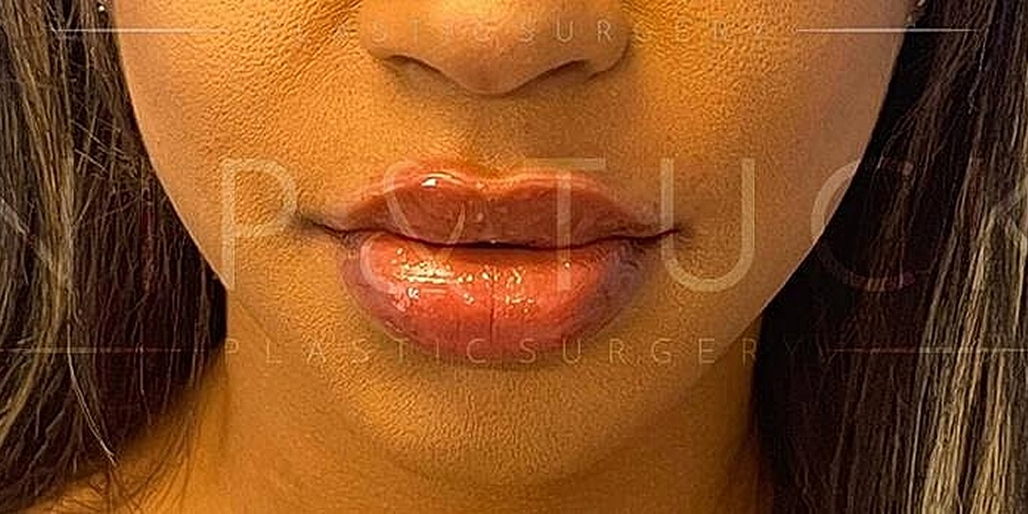 Lip Fillers Before & After