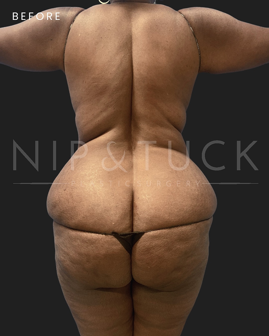 Lower Body Lift Before & After