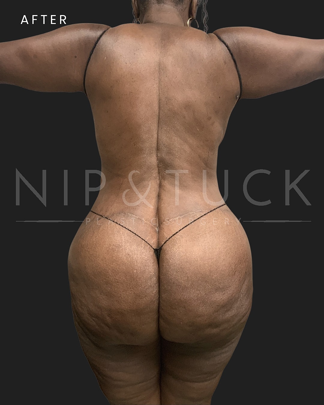 Lower Body Lift Before & After