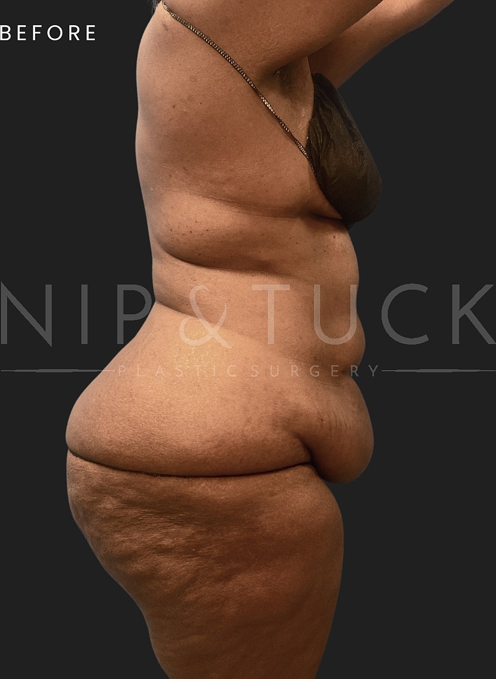 Lower Body Lift Before & After