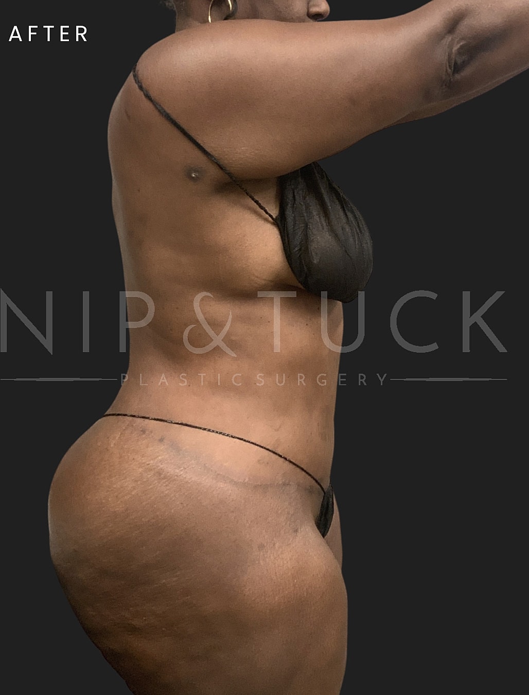 Lower Body Lift Before & After
