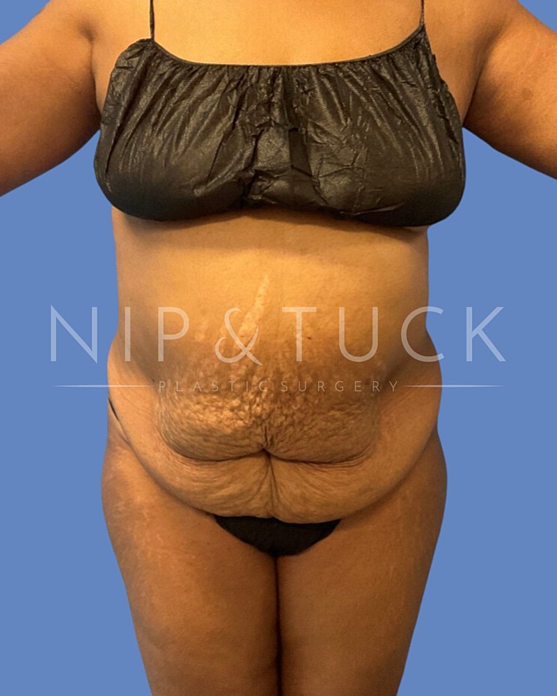 Abdominoplasty Before & After