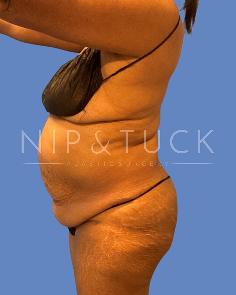 Abdominoplasty Before & After