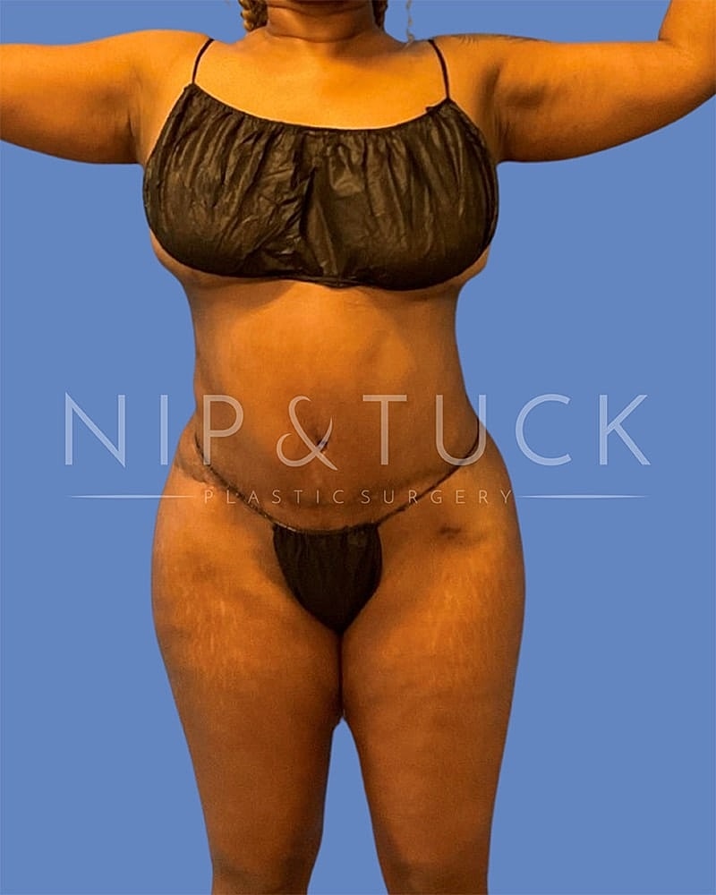 Abdominoplasty Before & After