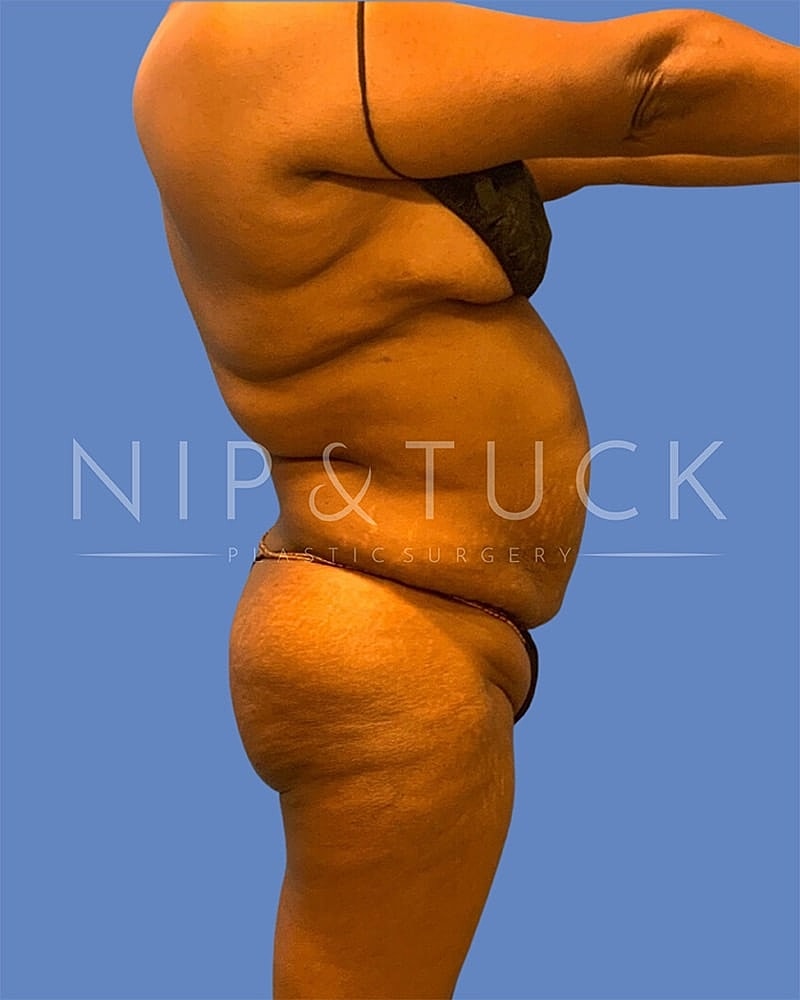 Abdominoplasty Before & After