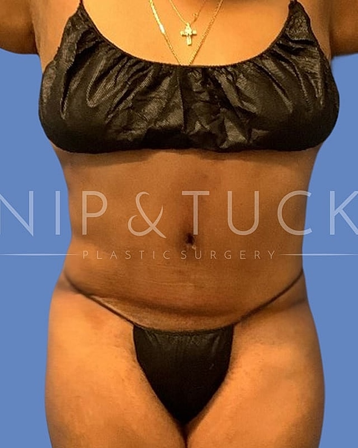 Person in bikini promoting cosmetic surgery service.