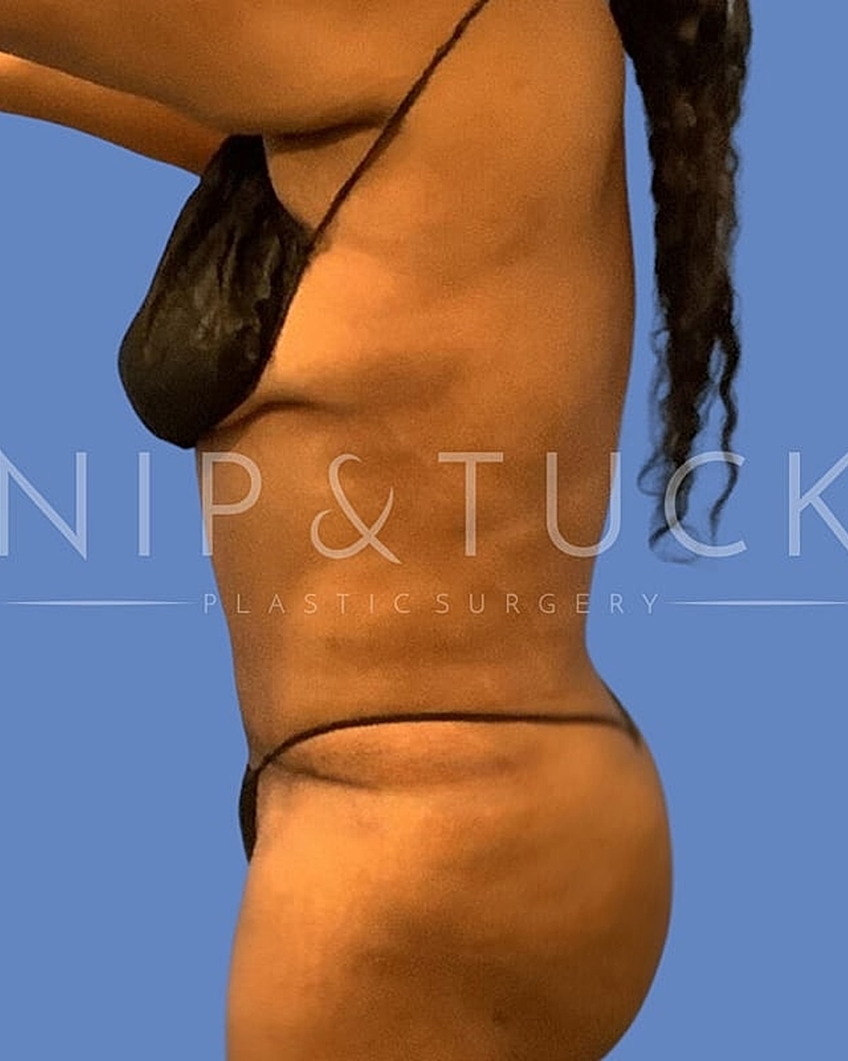 Abdominoplasty Before & After