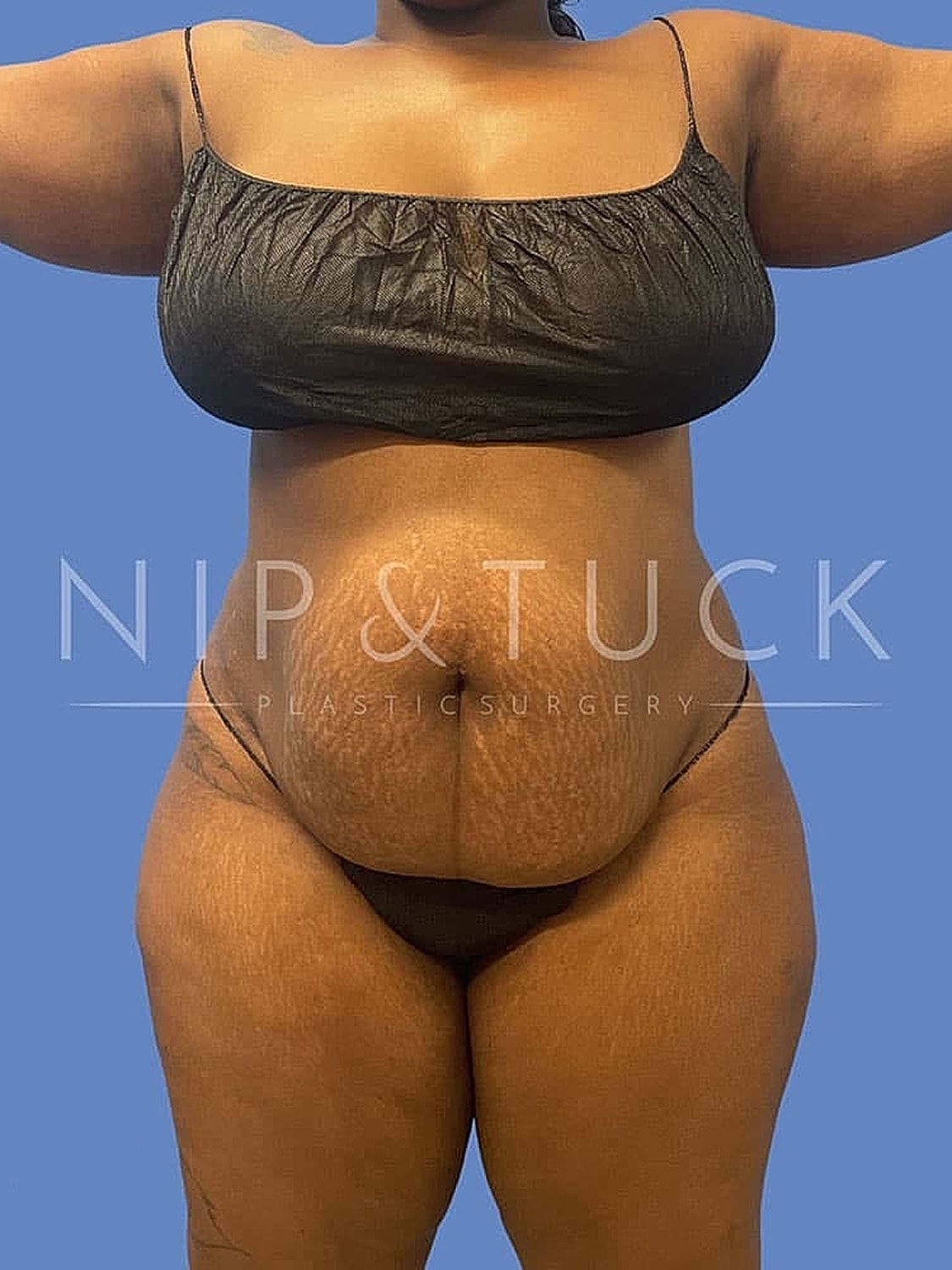 Before and after plastic surgery transformation.