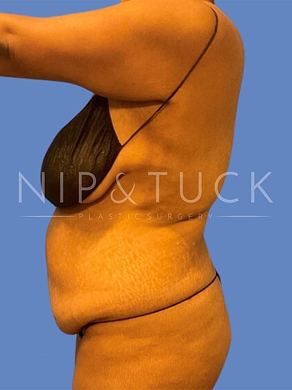 Abdominoplasty Before & After